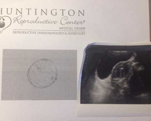 国内供卵公司包男孩,临沂试管婴儿医院排名最好内附试管婴儿费用及成功率参考