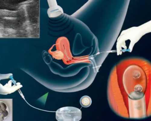 国内代怀在线咨询,试管婴儿治疗中激素针药会诱发肿瘤吗